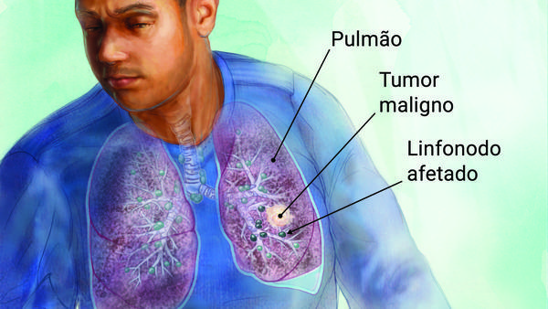 CÂNCER DE PULMÃO O QUE FAZER? SINTOMAS? TRATAMENTOS!!! QUIMIOTERAPIA-ONCOLOGIA CÂNCER DE PULMÃO O QUE FAZER? SINTOMAS? TRATAMENTOS!!! QUIMIOTERAPIA-ONCOLOGIA